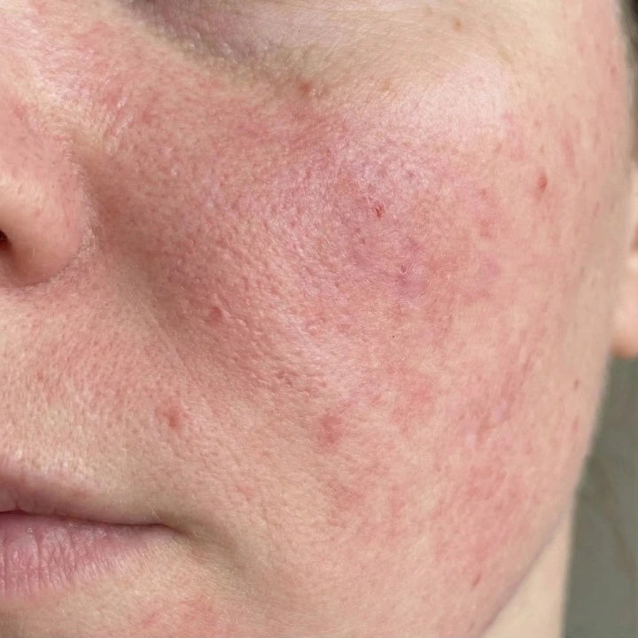 Redness That Shows Up Without Warning